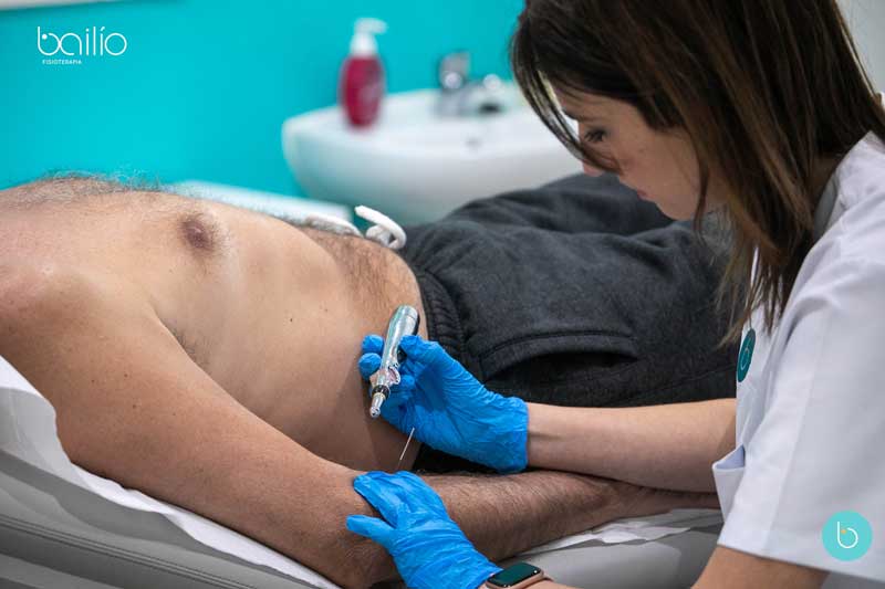 Neuromodulación Percutánea EPTE en Córdoba