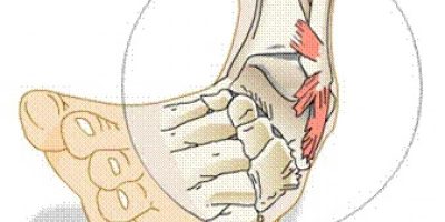 Cómo se produce el esguince