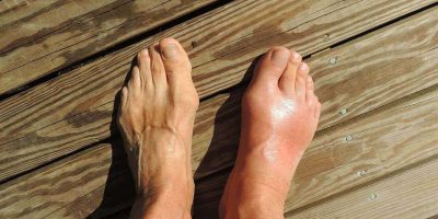 esguince tobillo mal curado